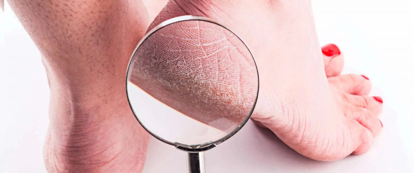 10 Cara Mengatasi Tumit Kering dan Kasar