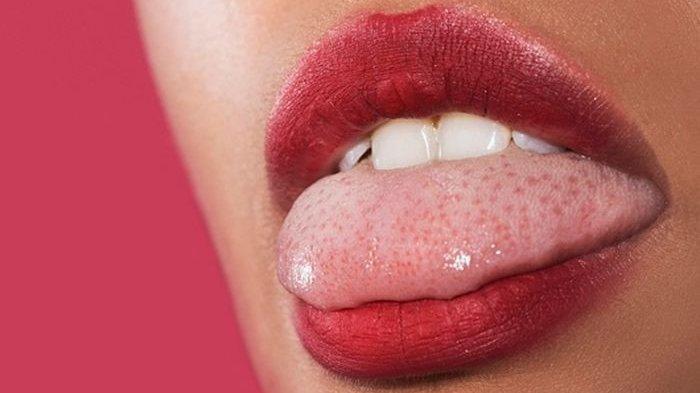 10 Cara Mendeteksi Penyakit Lewat Warna Lidah